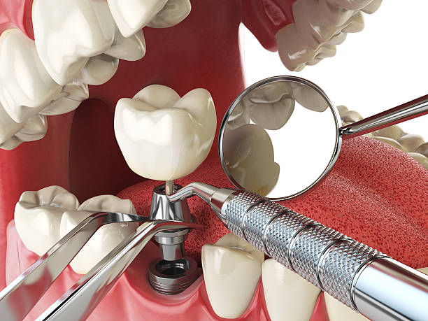 Best Emergency Tooth Extraction in Reading, MI